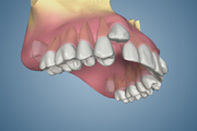 Canine Erupting on Buccal